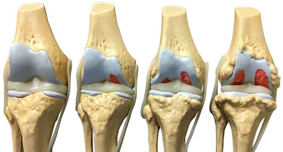 arthrose à traiter avec Hondrofrost