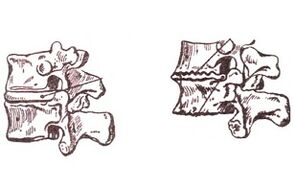Stades de développement de l'ostéochondose thoracique