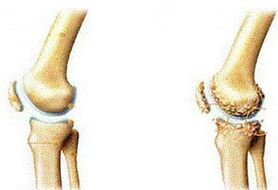 arthrose articulaire et articulation saine