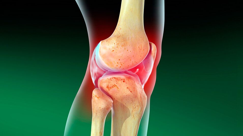 Arthrose de l'articulation du genou.