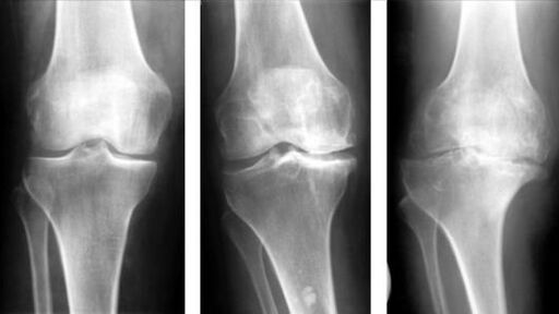 3 stades d'arthrose de l'articulation du genou. 